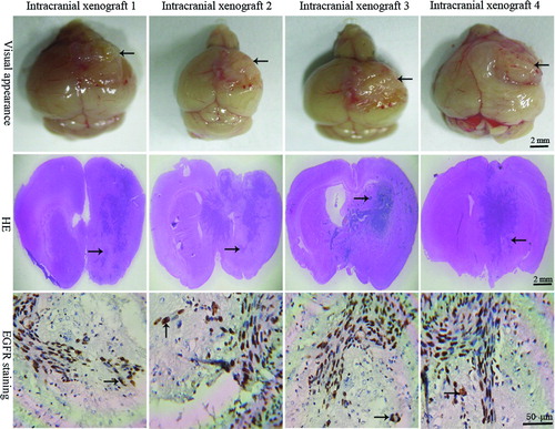 Figure 5  Highly invasive characteristics of intracranial xenografts. The 4 different intracranial xenografts generated from 4 corresponding flank GBM xenograft lines. Macroscopically, tumors (black arrow) grow up to the surface of ipsilateral cortex, blurring the border with surrounding normal host brain. In HE-stained sections, a large number of tumor cells can be seen migrating through the corpus callosum and extending into the opposite hemisphere, and the migrating tumor cells (black arrow) are clearly entering the normal host brain tissue, suggesting an invasive phenotype of intracranial GBM xenografts. EGFR immunostaining shows that single or clusters of tumor cells (buffy, black arrow) are infiltrating the surrounding normal host brain parenchyma.