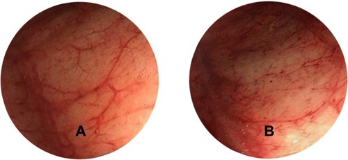 Figure 1 Representative endoscopic evaluation of rectal mucosa after intrarectal infusion of epinephrine. (A) Normal rectal mucosa before epinephrine. (B) Constriction of rectal mucosa after intrarectal use of epinephrine.