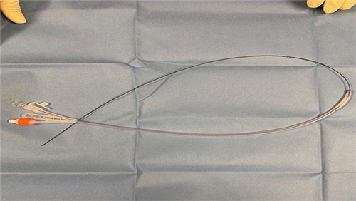 Figure 1 Photograph of the Urethrotech catheterisation device showing 100% silicone three-way Foley catheter 16 CH with an integrated Nitinol guidewire.