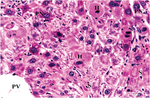 Figure 6. A photomicrograph of section of liver of HCC control group mouse showing significantly altered liver tissue. The hepatic strands are disorganized. The hepatocytes (H) are well-differentiated with eosinophilic cytoplasm. The nuclei are pleomorphic with prominent nucleoli (PN). Portal vein (PV) and compressed sinusoids (S) are also seen (HX & E x400).