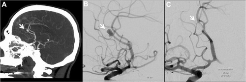 Figure 2 (A) Sagittal CT head angiography demonstrates A2 aneurysm (arrow). Diagnostic subtraction angiography (B) and (C) exhibit complete occlusion of A2 aneurysm after primary coiling (arrows).