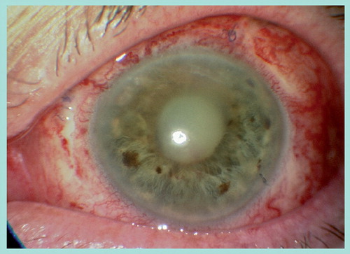 Figure 3. Endophthalmitis following intraocular surgery.Note the gross anterior segment hyperemia and absent red reflex. This case had no hypopyon, although this is typically present.Provided courtesy of JC Park (West of England Eye Unit, Royal Devon and Exeter NHS Foundation Trust, UK).