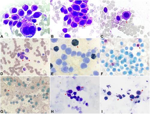 Figure 2 The features of morphology and chemical staining in the case. The morphology of Wright-Giemsa-stained marrow smear (A–C) and peripheral blood smear (D) was shown, 1000×, and the red triangle pointed to atypical mast cells. The results of chemical staining were negative for POX (E), NAS-DCE (F), and NSE (G), and was positive for Toluidine Blue (H–I), 1000×. The red triangles pointed to the positive cells in the corresponding staining.