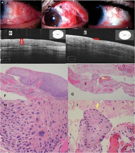 Figure 2 Case 2 (MMC group); a 56-year-old male with OSSN of the left eye, A–C: slit-lamp photographs: (A) preoperative shows a diffuse papillary lesion on the temporal conjunctiva with conjunctival fornices extension. (B) 1-week post-operative shows congested ocular surface which was reconstructed with AMG. (C) 2-year follow-up shows a complete resolution of the lesion. (D, E) AS-OCT images: (D) preoperative shows a thickened and hyper-reﬂective epithelium (red arrow). (E) 2-year follow-up; in the area of the previous lesion shows back to a normal thin epithelial thickness and appearance (red arrow). (F–I) Histopathological specimen [H&E, low power (F, G) & high power (H, I)]; sections reveal fibrovascular tissue with many congested blood vessels lined by stratified squamous epithelium. In some areas, there is atypia throughout the full thickness of epithelium with individual tumor cells and nests extending into underlying stroma. The tumor cells (yellow arrow) show eosinophilic cytoplasm, intercellular bridges and atypical nuclei with prominent nucleoli and coarse chromatin. Frequent mitotic figures, including atypical mitoses, are also seen. This is consistent with invasive squamous cell carcinoma; moderately differentiated and adjacent area shows moderate to severe dysplasia and intraepithelial neoplasia (carcinoma-in-situ).
