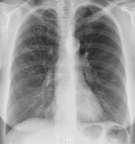 Figure 1 X-ray of a patient with coils in the right upper lobe.