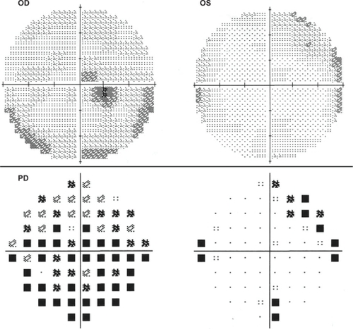 Figure 2 Static perimetry (full threshold 10-2 Humphrey visual field examination) shows central scotoma of right eye.
