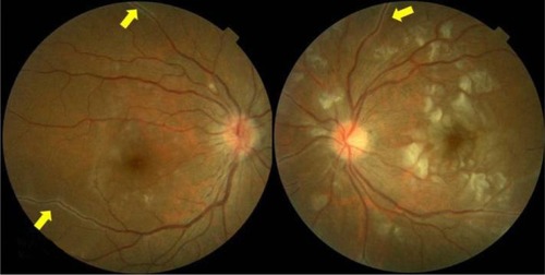 Figure 1 There was white perivascular hard exudate (yellow arrow) along the vessels in both eyes, and multiple patches of cotton-wool spots around the disk and macula in her left eye.