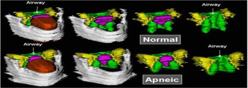 Figure S8 Volumetric reconstructions from a series of 3-mm contiguous axial magnetic resonance (MR) images of the mandible (gray), tongue (orange/rust), soft palate (pink/purple), lateral parapharyngeal fat pads (yellow), and lateral/posterior pharyngeal walls (green) in a normal subject (top panel) and in a patient with sleep apnea (bottom panel). The upper airway is larger in the normal subject than in the patient with apnea. In addition, the tongue, lateral parapharyngeal fat pads, and lateral pharyngeal walls are larger in the patient with apnea.Note: Reprinted with permission of the American Thoracic Society. Copyright © 2020 American Thoracic Society. Schwab RJ, Pasirstein M, Kaplan L, Pierson R, Mackley A, Hachadoorian R, et al. 2006. Family aggregation of upper airway soft tissue structures in normal subjects and patients with sleep apnea. Am J Respir Crit Care Med. 173. 453–63. Official journal of the American Thoracic Society.Citation145