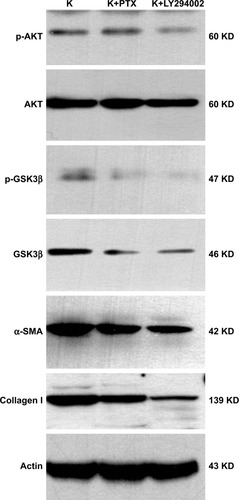 Figure 11 The expression of AKT/GSK3β signaling and the production of α-SMA and collagen I in HKFs.Note: Cultured HKFs were deal with PTX (0.1 µg/mL) or LY294002 (5 µM/mL) for 24 hours, followed by immunoblot analysis for AKT, p-AKT, GSK3β, p-GSK3β, α-SMA and collagen I, and normalized with actin.Abbreviations: α-SMA, alpha smooth muscle actin; AKT, protein kinase B; GSK3β, glycogen synthase kinase 3 beta; p-AKT, phosphorylation-protein kinase B; HKFs, human keloid fibroblasts; p-GSK3β, phosphorylation-glycogen synthase kinase 3 beta; PTX, paclitaxel.