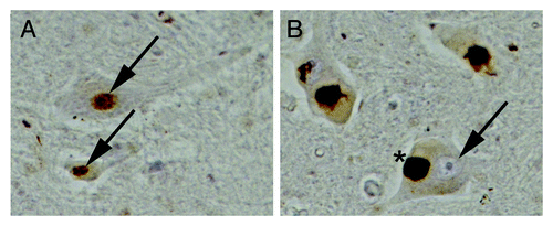 Figure 2. TDP-43 in ALS: Gain or loss-of-function? Spinal cord sections from an unaffected individual (A) or from an ALS patient (B) immunostained for TDP-43. (A) In the unaffected individual, TDP-43 is localized to the nucleus of motor neurons (arrows). (B) In motor neurons of ALS patients TDP-43 is depleted from the nucleus (arrow) and accumulates in the cytoplasm in large aggregates (*).