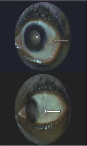 Figure 5 Left eye 8 months after initiating the treatment with sulfasalazine.