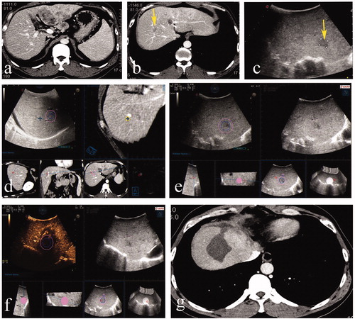 Figure 2. A 43-year-old male. (a, b) Contrast-enhanced CT indicated a massive hepatocellular carcinoma in the left liver with a small lesion located in segment 8. (c) Hepatectomy was performed before ablation, and the small lesion was hypoechoic on US. (d) Deformation of liver after hepatectomy led to the failure of registration of US and preablation CT volume images. (e) Immediately acquired 3DUS volume images were successfully matched to the real-time US. (f) After the ablation procedure, CEUS was performed and fused with preablation 3DUS. The ablation zone completely covered the target tumor and the 5-mm ablative margin. (g) Subsequent contrast-enhanced CT within three months confirmed that the tumor had been completely ablated.