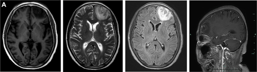 Figure 2 Brain MRI images of the patient. (A) Brain MRI on December 30, 2021.