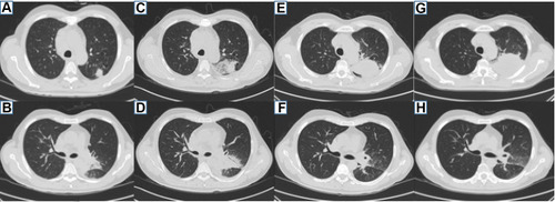 Figure 3 Patient 2 chest CT. (A and B) Multiple nodules in the upper lobe of the left lung and a mass in the left hilar lung on January 24, 2018. (C and D) The lung lesions of the upper lobe of the left lung and left hilar lung increased on January 31, 2018. (E and F) The lesion in the upper lobe of the left lung was enlarged, and the mass of left hilar was reduced, on August 27, 2018. (G and H) The lesion in the upper lobe of the left lung continued to enlarge, and the mass of left hilar was the same as before on November 6, 2018.
