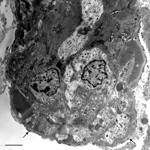 Figure 3 Kidney biopsy performed in 2019: electron micrograph showing an extensive circumferential electron-dense deposits (asterisks), and visceral epithelial foot process effacement (arrows). Scale bar 2.7 μm.