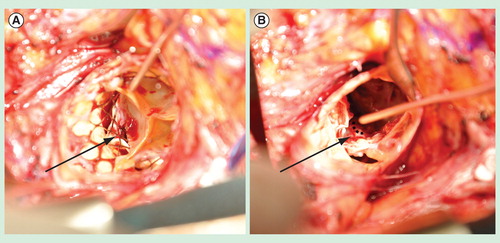 Figure 2. The anatomy of a typical posterior paravalvular leak after transcatheter aortic valve implantation, as viewed intraoperatively during valve explantation. (A) Intraoperative photograph demonstrating an aortic annular triangular gap (arrow) between two calcified cusps of the native aortic valve and the implanted transcatheter aortic valve implantation (TAVI) prosthesis. This patient had developed symptomatic, moderate-to-severe paravalvular leak 18 months after implantation of the TAVI prosthesis, necessitating re-operative aortic valve replacement. (B) Intraoperative photograph taken after surgical removal of the TAVI prosthesis, demonstrating the bulky calcium at the base of the left coronary cusp and non-coronary cusp, leaving a triangular gap at the commissure preventing apposition of the TAVI prosthesis (dashed line) against the native aortic annulus.