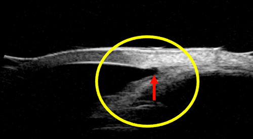Figure 2 Ultrasound biomicroscopy image of a goniotomy opening (yellow outline) with a widened iridocorneal angle (indicated by red arrow).