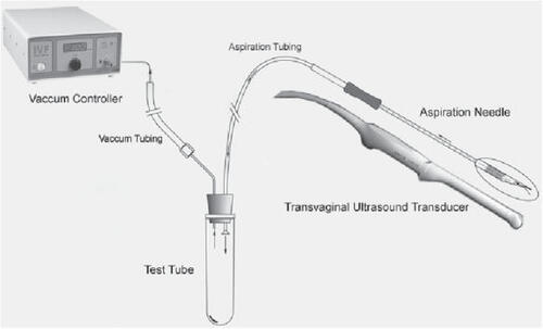 Figure 3 Schematic of modern outpatient in vitro fertilization setup. Copyright © 2006. Reproduced with permission from Cook Group Incorporated. 2006. Ovum aspiration diagram [online]. Accessed on 2 January 2006. URL: http://www.cookwomenshealth.com/products/infertility/1_01/1_01_01a.html.