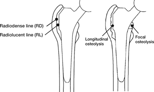Figure 1. A. Illustration showing definition of radiolucent line (RL) and radiodense line (RD) around proximal stem. B. Illustration showing definition of osteolysis (longitudinal and focal) around proximal stem.