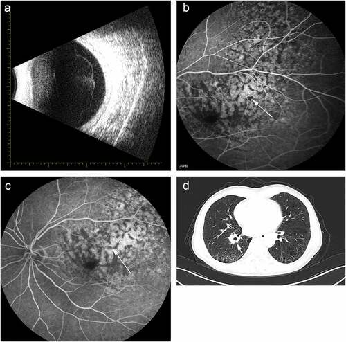 Figure 2. Ocular and medical imaging examination of post-immunotherapy. (a) Ocular ultrasonography. (b) The early stage of FFA. (c) The late stage of FFA. (d) Chest high-resolution CT