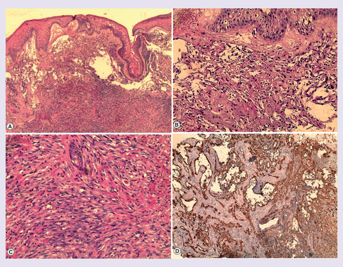 Figure 3.  Histopathology and immunohistochemistry.(Hematoxylin–eosin stain) (A) 20× magnification (B) 40× magnification (C) 100× magnification. (A,B,C) Tumor proliferation occupying the entire dermis, anastomozing, irregular and dilated vascular slits with irregular lumina lined by atypical endothelial cells, which showed nuclear atypia with mitotic figures. In the deep dermis; massive proliferation of atypical fusiform cells with enlarged hyperchromatic nuclei and cytoplasmatic vacuoles, extensive extravasation of red blood cells without necrosis. (D) Immunochemistry for CD31 and CD34.