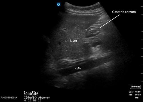 Figure 2 Point-of-care gastric ultrasound in right lateral decubitus position. There is a small amount of clear liquid in the stomach. The cross-sectional area of the gastric antrum was 2.65 cm2.