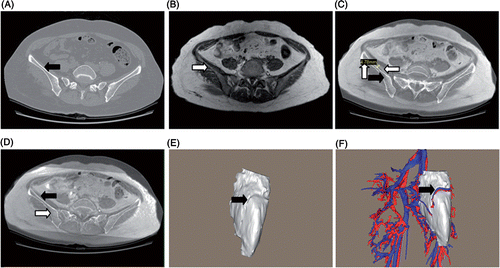 Figure 3. Assessment of image fusion accuracy. One method of assessment is to assess the overlay degree of the bone contours on the fused 2D images: (A) CT image: the black arrow shows the iliac contour; (B) MRI image: the white arrow shows the iliac contour; (C) The fused image with large deviation: horizontal arrows show that the iliac contours are not well overlaid and the vertical arrow shows the largest deviation of the iliac contours; (D) The accurately fused image: arrows show well-overlaid iliac contours. Another method is to assess the mutual fitness relationship between 3D models: (E) 3D tumor model: the arrow shows the vascular channel on the tumor surface; (F) 3D models of the tumor and peritumoral vessels assembled by the accurate image fusion: the arrow shows that one branch of the superior gluteal vessel only runs through the vascular channel. Fusion accuracy as in (D) and (F) is the satisfactory result for each image fusion.