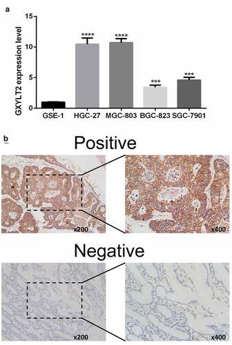 Figure 6. Verification of upregulation of GXYLT2 expression levels in GC by qRT-PCR and Immunohistochemistry test. (a)The mRNA levels of GXYLT2 in normal gastric cell and gastric cancer cell lines. (b) Representative images of GXYLT2 immunohistochemistry in GC tissue