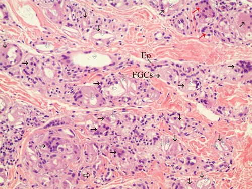 Figure 7 200× magnification on the left area of Figure 5 (H&E stain). Particles smaller than 20 microns were assumed to be particles that were injected 7 months before the biopsy and demonstrated late stage of inflammation in tissue reaction. FGCs (black arrow) ingested and cleaved CaHA particles and showed CaHA biodegradation. FGCs always positioned between new collagen fibers and CaHA particles (white arrows). The nuclei were centrally placed and overlapped each other in most FGCs. In some FGCs, ingested CaHA particles had displaced nuclei of FGCs peripherally. But in a few giant cells, the nuclei were arranged on the border as horseshoe shape like Langhans giant cell (red arrow). New vessels (empty black arrows) with a red blood cell its inside  was visible and and demonstrated neovascularization by CaHA filler. A eosinophil (Eo) was found.