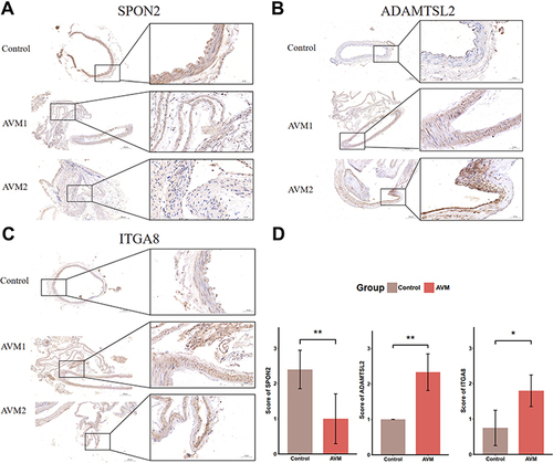 Figure 9 Detection of SPON2, ADAMTSL2, and ITGA8 in human tissue sample. Immunohistochemical staining of control (up) and AVM (middle and bottom) tissue samples for SPON2 (A), ADAMTSL2 (B) and ITGA8 (C). (D) shows the significant difference of staining scores of SPON2, ADAMTSL2, and ITGA8. AVM indicates brain arteriovenous malformations. *p-value < 0.05, **p-value < 0.01.