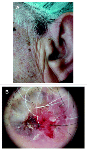 Figure 4. (A) Histologically confirmed nodular BCC in left preauricular area of a male patient. (B) Dermoscopic picture on same patient, showing central necrosis, maple leaf-like structures, blue-ovoid nests, blue-gray globules, and arborising vessels.