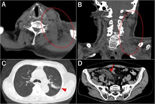 Figure 1 Images of the chest-abdominal CT scan. (A and B) Swollen left levator scapulae muscle and enlarged lymph nodes in the left neck (red circle). (C) A consolidation with an interlobular pleural shift in the left lung (arrowhead). (D) A consolidation in the abdominal soft tissue (arrow).