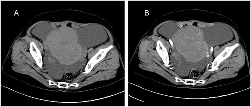 Figure 3 (A) Abdominal computed tomography revealed a soft tissue mass measuring approximately 10.9 × 8.2 × 14.3 cm with a clear boundary and heterogeneous density; (B) Contrast-enhanced scan showed no obvious enhancement and revealed that the supplying artery originated from the left ovarian artery.