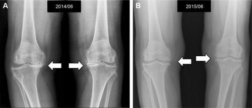 Figure 3 Standard weight-bearing knee X-rays of a 76-year-old female before (A) and 1 year after (B) two courses of intra-articular PRP in association with HA injection, showing more significant bone spur growth and the cartilage remains at a healthy size with the normal joint space (white arrows).