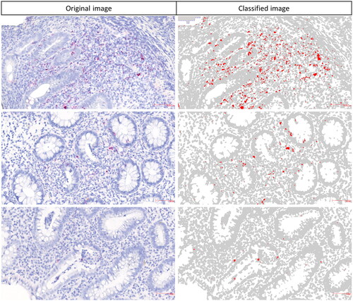 Figure 1. Quantification of TNF mRNA levels in IBD tissue. Digital slides of the TNF mRNA ISH stained sections were submitted to colour segmentation-based image analysis. Original images with the TNF mRNA ISH signal (left) and corresponding colour classified images (right). Relative expression estimates were obtained as area fractions (red area/total area of ROI). Precision of the colour segmentation system at different signal intensities are shown here.