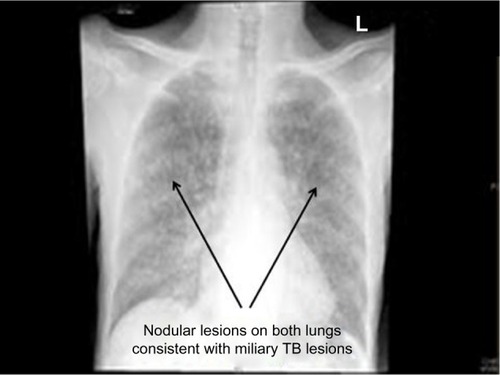 Figure 1 Chest X-ray showing nodular lesions on both lungs consistent with miliary TB lesions.