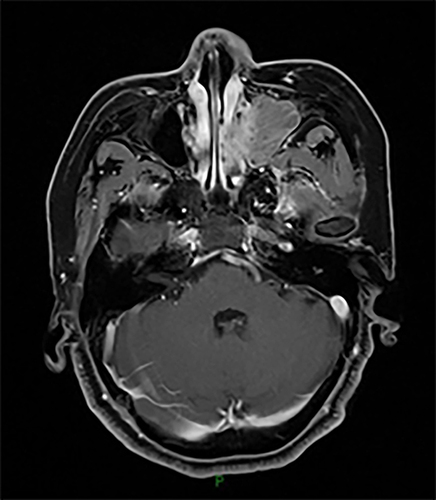Figure 3 MRI image taken before the first sinus tumor resection.