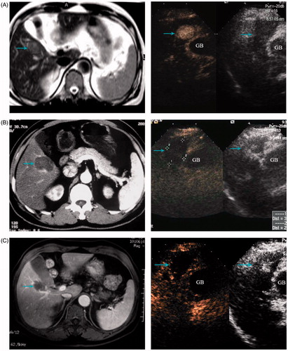 Figure 3. A 68-year-old man treated with MW ablation for HCC adjacent to the gallbladder. (A) Before ablation the tumour (arrowhead) is seen in MRI scans. (B) Six months after ablation, the ablation zone (arrowhead) has no arterial enhancing in CT scans (left) and contrast enhanced ultrasound (right). (C) MRI scans (left) and contrast enhanced ultrasound (right) from 1-year follow up show the ablation zone (arrowhead) had no local tumour progression.
