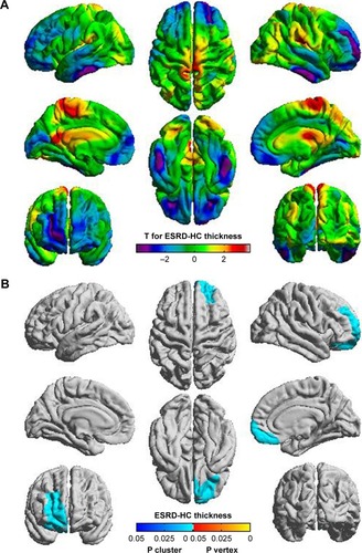 Figure 1 Cortical thickness comparison between patients with ESRD and HCs. (A) Group difference in cortical thickness shown as a T-value map, positive T-values (red, yellow) indicate thicker cortical thickness in HC group. (B) Two P-values (P-values for each vertex and P-values for each cluster) are shown simultaneously. The P-value for clusters indicates significant corrected P-values with the lightest blue color, and the P-value for vertices indicates significant corrected P-values with the lightest yellow color. Only one cluster (blue, right prefrontal cortex) showed thinner cortical thickness in patients with ESRD.