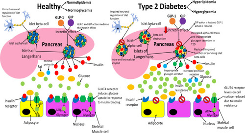 Figure 3 Comparing healthy and type 2 diabetic phenotypes. In healthy individuals, insulin is produced and secreted by beta-cells in the islets of Langerhans (found in the pancreas) when blood glucose levels are above 5mM. Beta-cells are the most abundant cell type in the islets (~70%) and alpha-cells (responsible for glucagon secretion) are the second most abundant (~20%). Insulin then binds to the insulin receptor (IR), which allows uptake of glucose into tissues by inducing translocation of GLUT4 receptors from intracellular vesicles to the plasma membrane. GLUT4 is primarily found in adipose tissue as well as skeletal and cardiac muscle. Glucose is then transported into the cell by GLUT4 from the bloodstream and catabolised in the cell for ATP production, which provides the fuel for intracellular processes, or glucose can be converted to either glycogen or fat for fuel storage after uptake. In individuals with T2D, many islet beta-cells have undergone apoptosis and the function of the surviving cells is impaired, which results in markedly reduced insulin levels in circulation. Additionally, peripheral tissue insulin resistance impairs the action of insulin, resulting in reduced uptake of glucose from circulation, as a result of decreased GLUT4 translocation to the membrane. Reduced insulin levels and action result in hyperglycaemia and hyperlipidaemia, and subsequent T2D associated symptoms manifest in the patient. Inappropriate glucagon secretion, diminished incretin hormone action, increased proinsulin secretion, impaired pancreatic islet neural regulation, and islet amyloid deposition are also characteristic of T2D. This figure and information in its legend are with data adapted from these studies.Citation105,Citation106,Citation111,Citation326–Citation328