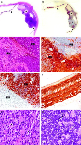 Figure 2.  Histology and immunohistochemistry of Case 1. a. H&E staining and b. p75NTR immunohistochemistry of the whole eye. Normal retina (arrow-head), retinoblastoma (asterisk) and retinoma (arrows) are shown. c. H&E staining (original magnification 100x) of retinoma (RN) and retinoblastoma (RB). d. Positive immunostaining for p75NTR (original magnification 100x) in retinoma (RN), while retinoblastoma cells (RB) are not stained as well as inflammatory cells inside the tumor. Spikes of positivity inside the tumor represent residues of neuron bodies and their elongation and vessel walls. e. Widespread Ki-67 nuclear cell immunostaining in RB cells indicates a high proliferation index, while retinoma cells are negative (original magnification 100X). f. Higher magnification of normal retina stained with p75NTR (original magnification 200X). p75NTR positivity in the retina is diffuse and includes neuron bodies and elongate processes of all the retina layers; outer segments of cones and rods are not stained. g. Higher magnification of retinoma (H&E staining, original magnification 200X) showing fleurettes (see arrows). h. Higher magnification of retinoblastoma (H&E stain, original magnification 200X) displaying Homer Wright rosettes (see arrows).