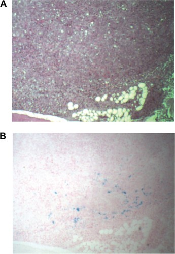 Figure 5 Hematoxylin and eosin staining (A) and Prussian blue staining (B) of PANC-1 cells in nude mouse tumor tissue electroporated 3 minutes before administration of iron nanoparticles.