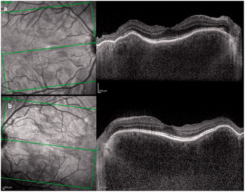 FIGURE 1. (a) Right and (b) left eye: SD-OCT horizontal scan showing remarkable retinochoroidal folds.