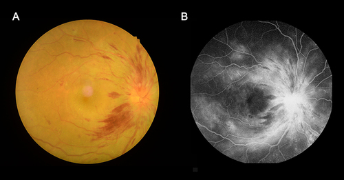 Figure 1 Eye examination data of DON patients.