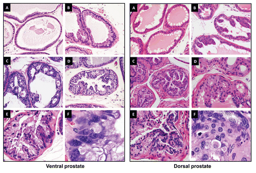 Figure 3 Representative lesions in PB-PKCε mice. Left panels. H&E stained sections of VP from PKCε mice. (A) (20x) VP showing a single stratum of luminal epithelial cells with normal lower flat and cylindrical shaped cells projecting into the gland. (B) (20x) VP showing luminal epithelial hyperplasia, few cells present nuclear atypia. (C and D) (20x) Representative examples from VP glands presenting PIN lesions with cribriform pattern (C) and a mixed of tufting with micropapillary pattern (D). Cells display from moderate to strong cellular atypia. Note also the nucleus adopting an apical localization. (E) (40x) This lesion displays a mild to moderate dysplastic luminal epithelium and the presence of nuclear atypia. Kariomegaly and kariocytomegaly are common findings. (F) (100x) Clusters of cells presenting severe dysplasia. Note the difference in the shape and size of the nucleus as well as the large number of nucleoli. Right panels. H&E stained sections of the DP from PKCε mice. (A) (20x) Normal glands showing cubical shaped cells with normal mucosal folding projected into the lumen. (B) (20x) DP showing luminal epithelial hyperplasia with increased cellular tufting but without cellular atypia. (C) (20x) A mixed hyperplasia with cellular atypia and PIN lesion with mild dysplasia. (D) (40x) Some of the PIN lesions display many small “intraluminal glands.” (E) (40x) Highly dysplastic PIN lesion with increased epithelial tufting and micropapillary pattern. (F) (100x) Higher magnification from a PIN showing dysplastic cells with enlarged nucleus presenting one or more large nucleoli.