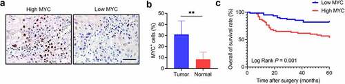 Figure 1. MYC expression correlates with HNSCC prognosis. (a) Immunochemistry showing MYC expression in HNSCC samples. Scale bar, 50 μm. (b) The MYC expression in HNSCC and adjacent normal tissues. n = 20, **P < .01 by a paired Student’s t test. (c) Kaplan–Meier curves with log-rank tests showing that patients with high MYC expression had shorter survival than those with low MYC expression (P = .001).