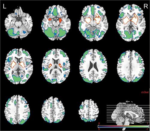 Figure 2 Abnormal glucose uptake in ENKTL patients compared with the CG. PET findings were superimposed on an MRI template to facilitate accurate identification of the affected structures. The increased regions are shown in red-to-white color and include both bilateral lentiform nuclei with slight extension to the adjacent claustrum and parahippocampal gyrus, especially in the putamen, amygdala, and hippocampus. The decreased regions are displayed with blue-to-green color and include the bilateral frontal cortex, parietal cortex, occipital cortex, temporal cortex, and cerebellum (p<0.001). Color bar indicates t-values.