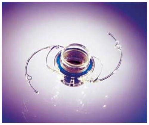 Figure 1 Implantable Miniature Telescope (IMT by Dr Isaaz Lipshitz; VisionCare Ophthalmic Technologies, Saratoga, CA, USA).Citation18