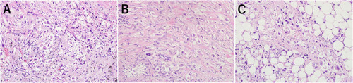 Figure 3 The microscopic findings of the tumors with hematoxylin–eosin staining. (A) The lung tumor was composed of poorly differentiated polymorphic cells mixed with spindle cells. (B) Thickened and invaded with atypical malignant cells in the left neck. (C) The mesentery had also been invaded by similar malignant cells as the lung and neck.