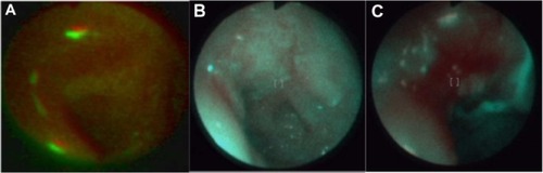 Figure 14 Monitoring the effect of ulceration treatment with photodynamic therapy: before (A), after (B), control after 3 months (C).